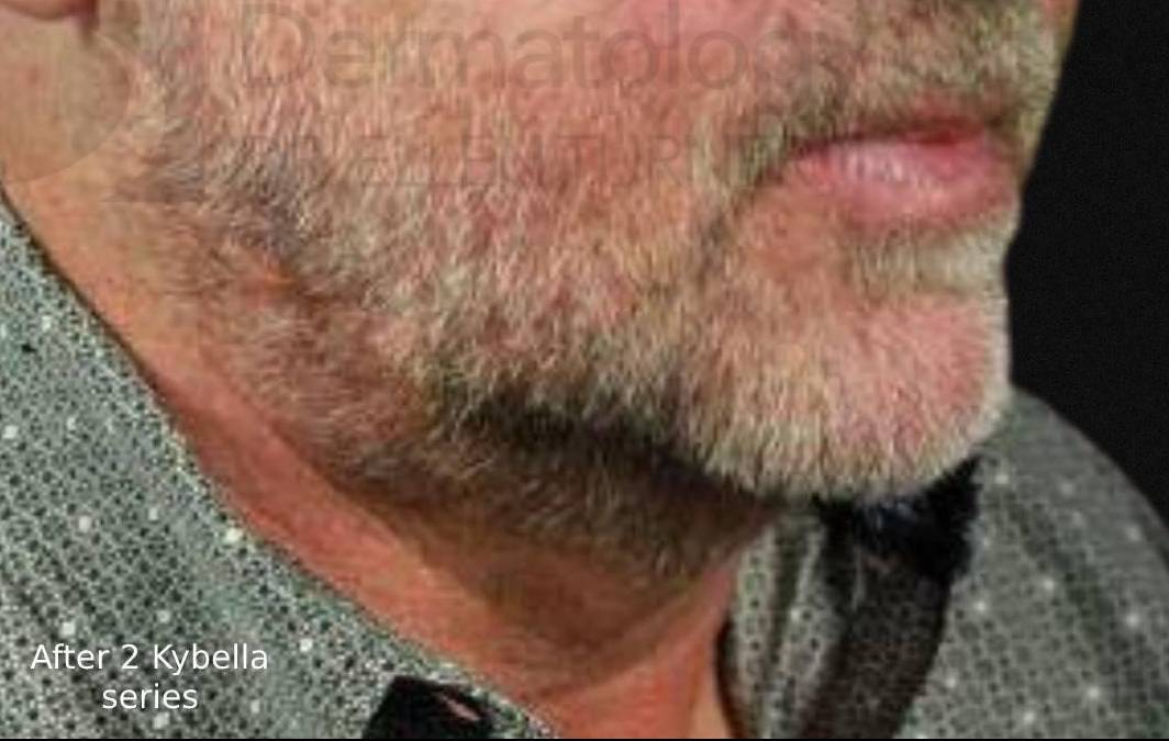 Kybella After