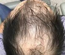 Hair Restoration Before