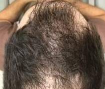 Hair Restoration After