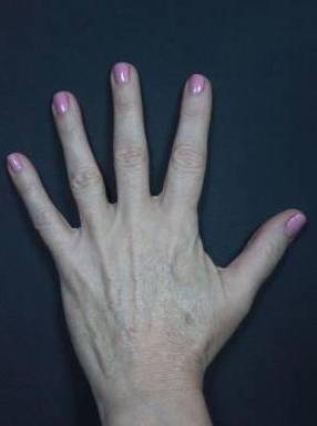 Hand Rejuvenation Before