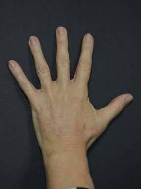 Hand Rejuvenation After