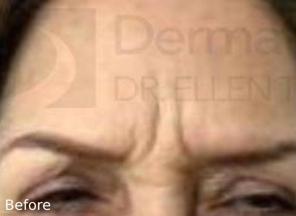 Botox Before