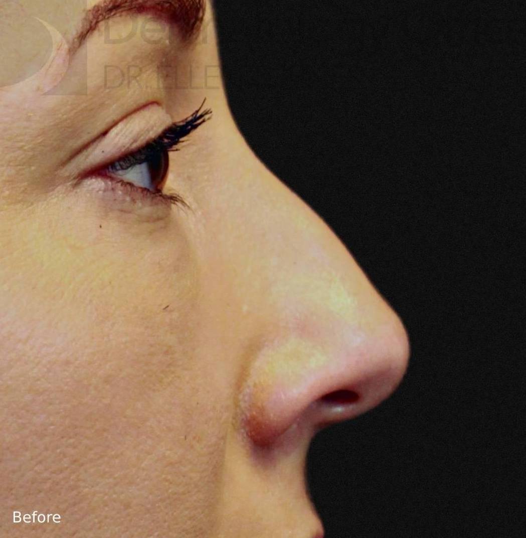 Injectable Rhinoplasty Before