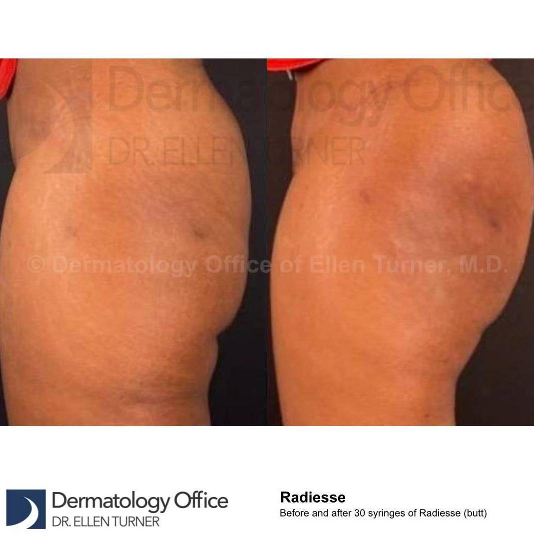 Radiesse Butt Augmentation 