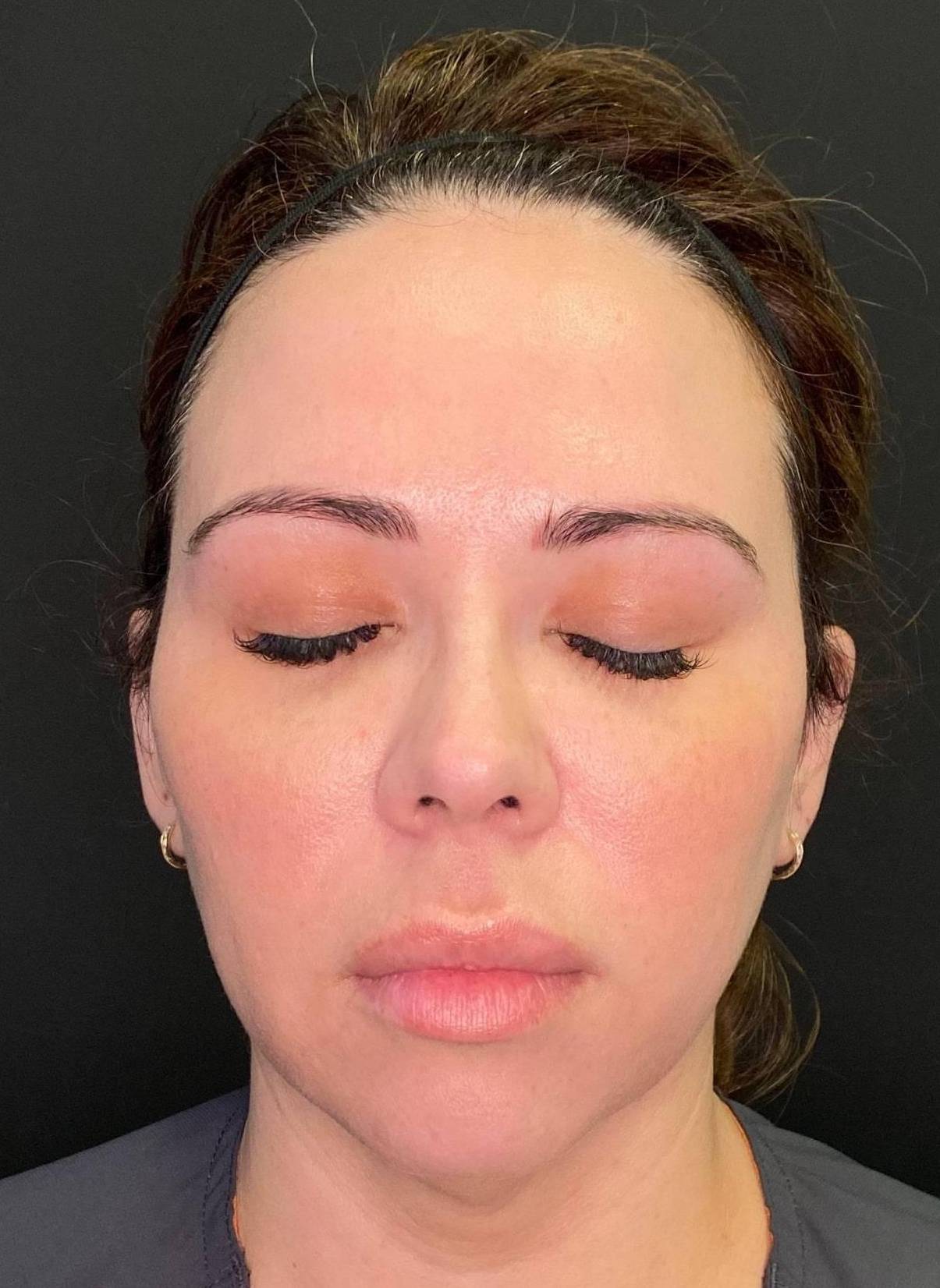 Teoxane RHA Filler Before