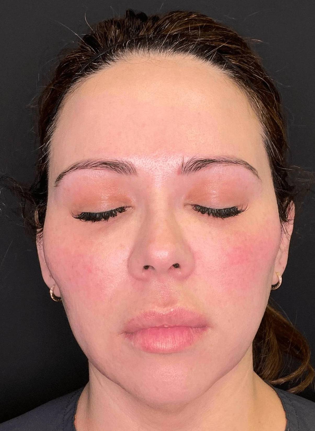 Teoxane RHA Filler After