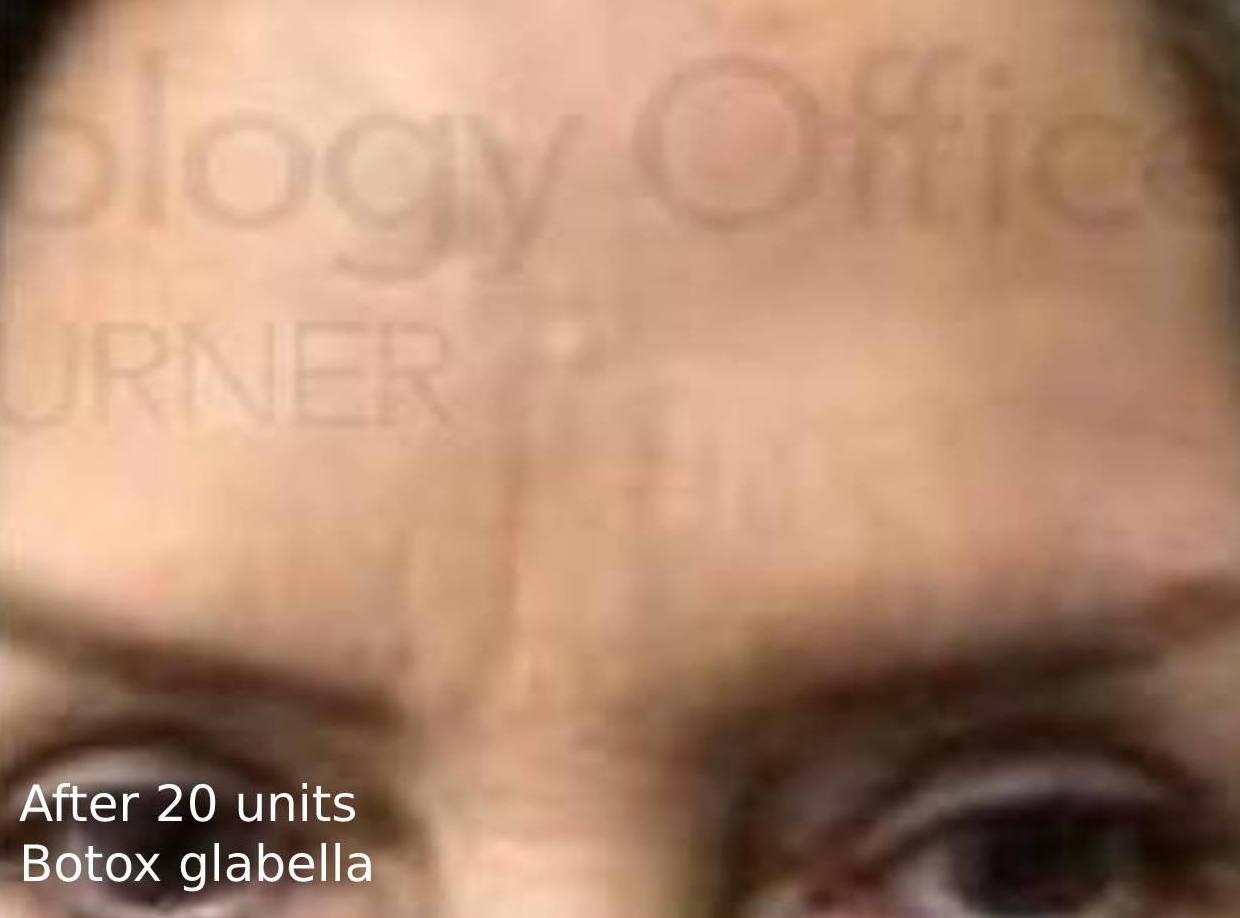 Botox After