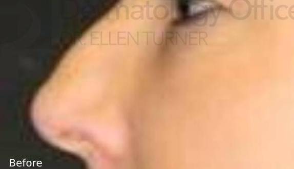 Injectable Rhinoplasty (1 Syringe) Before and After Case 1 Before