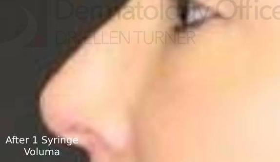 Injectable Rhinoplasty (1 Syringe) Before and After Case 1 After