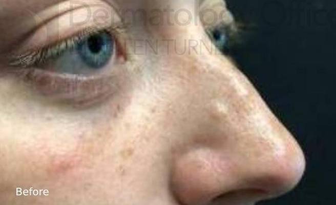 Injectable Rhinoplasty Before and After Case 2 Before