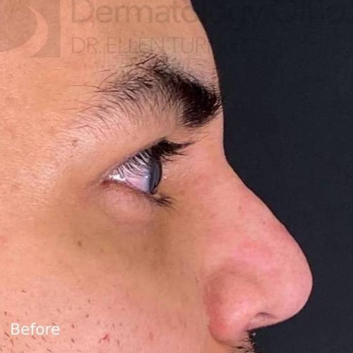 Injectable Rhinoplasty (1 Syringe) Before and After Case 3 Before