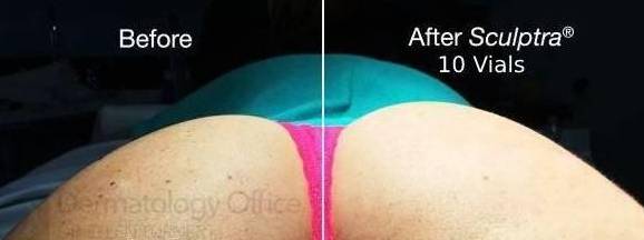 Buttocks Augmentation 