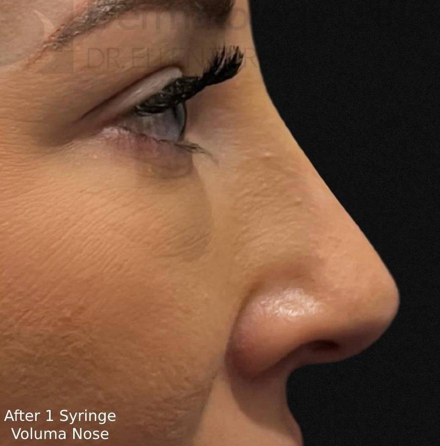 Injectable Rhinoplasty (1 Syringe Voluma) Case-4 After